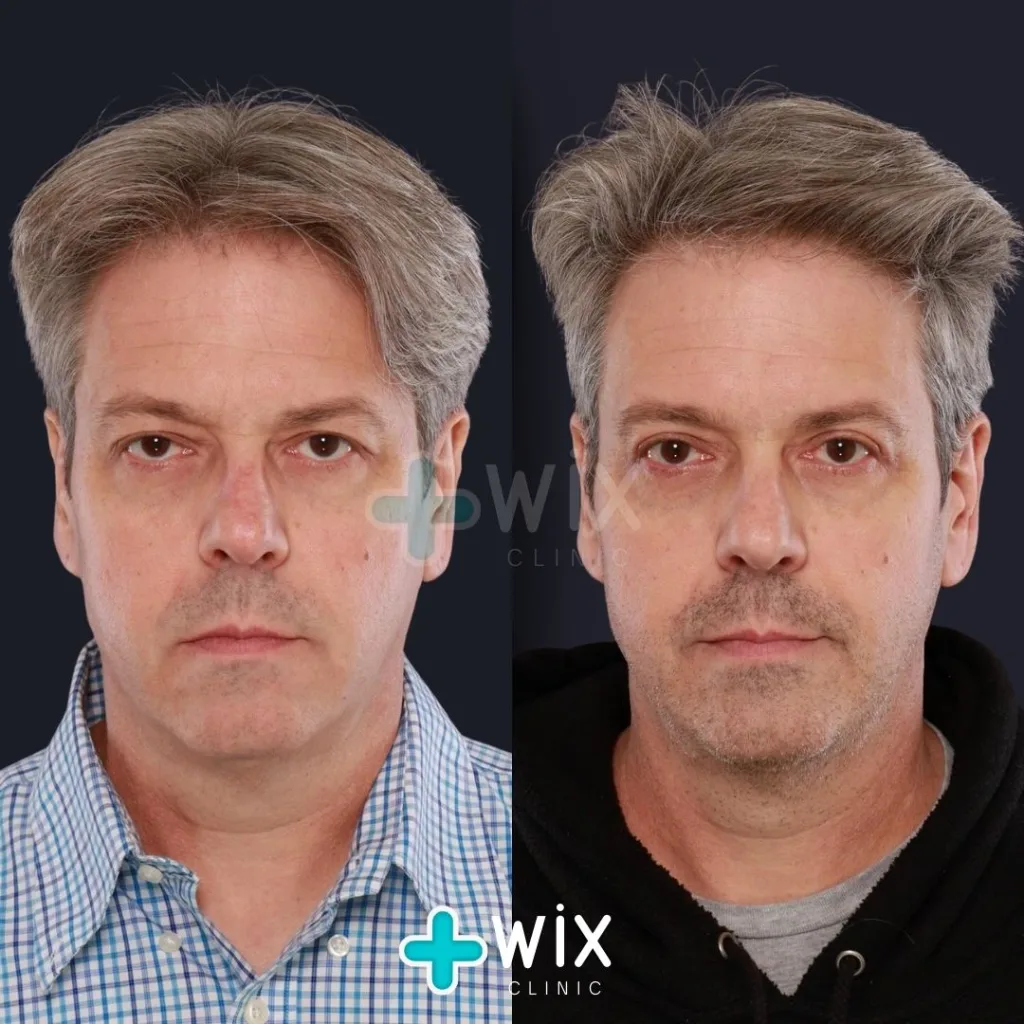 Blepharoplasty Before and After