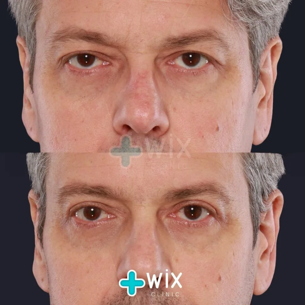 Blepharoplasty Before and After