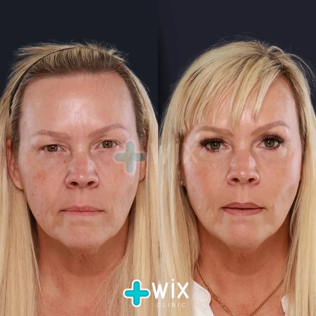 Blepharoplasty Before and After