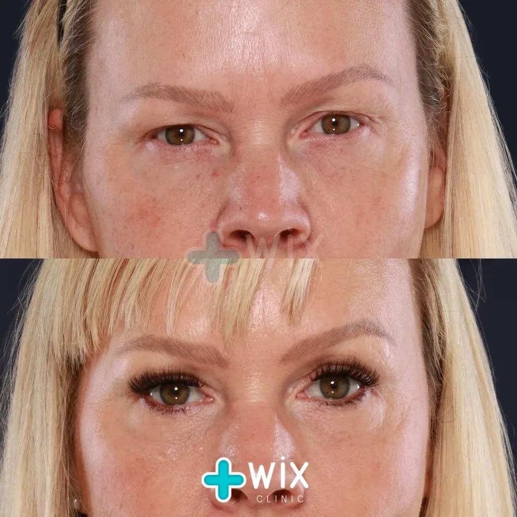 Blepharoplasty Before and After