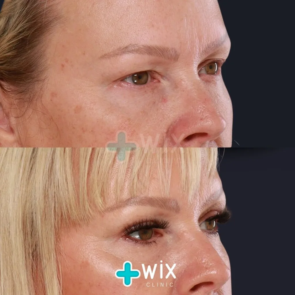 Blepharoplasty Before and After