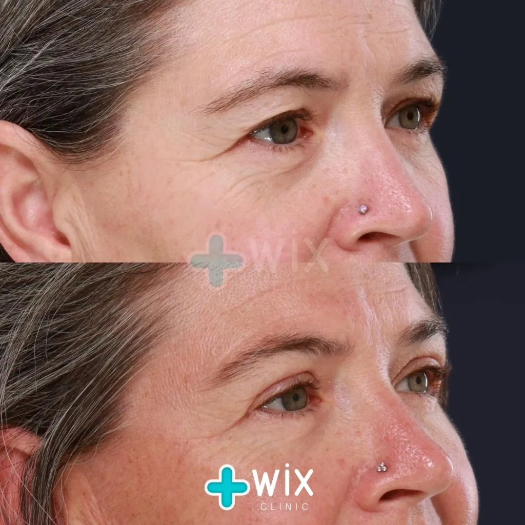 Blepharoplasty Before and After