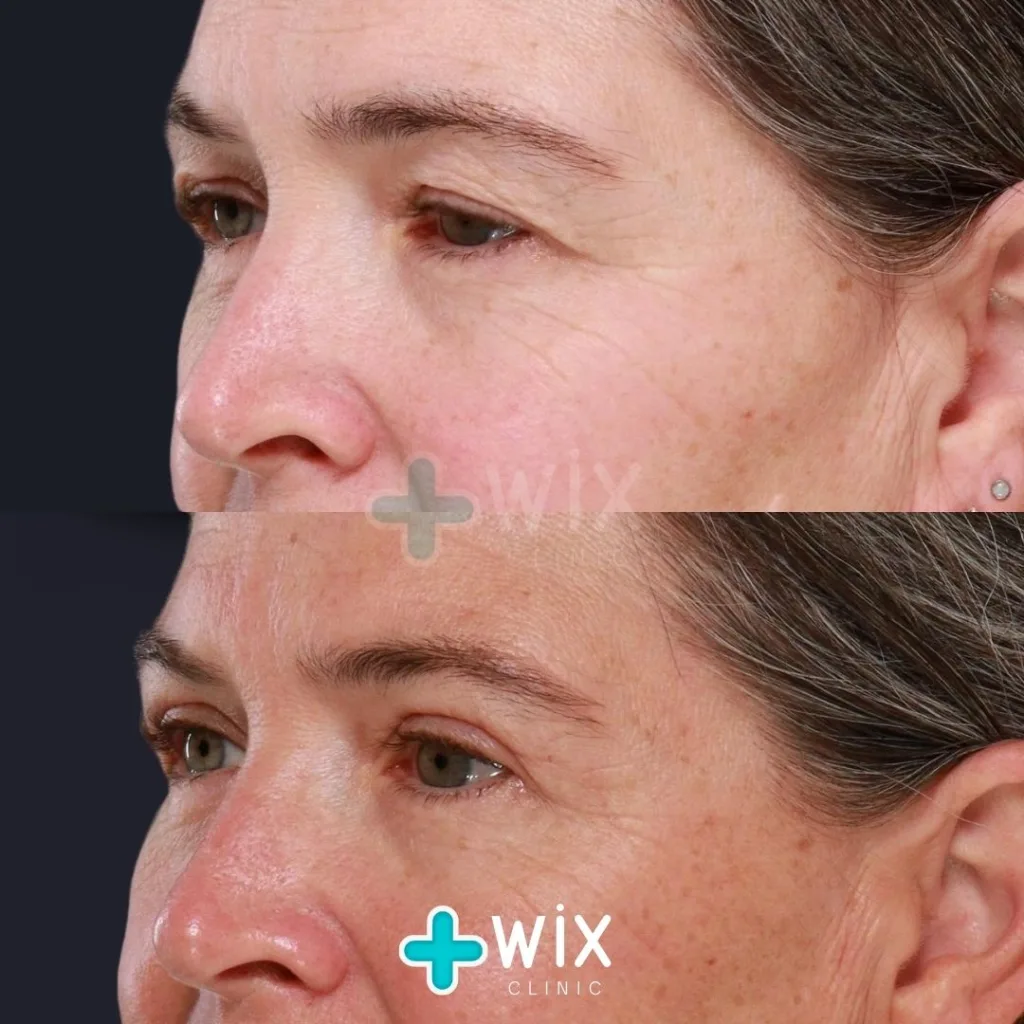 Blepharoplasty Before and After