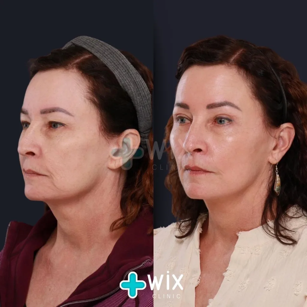 Blepharoplasty Before and After