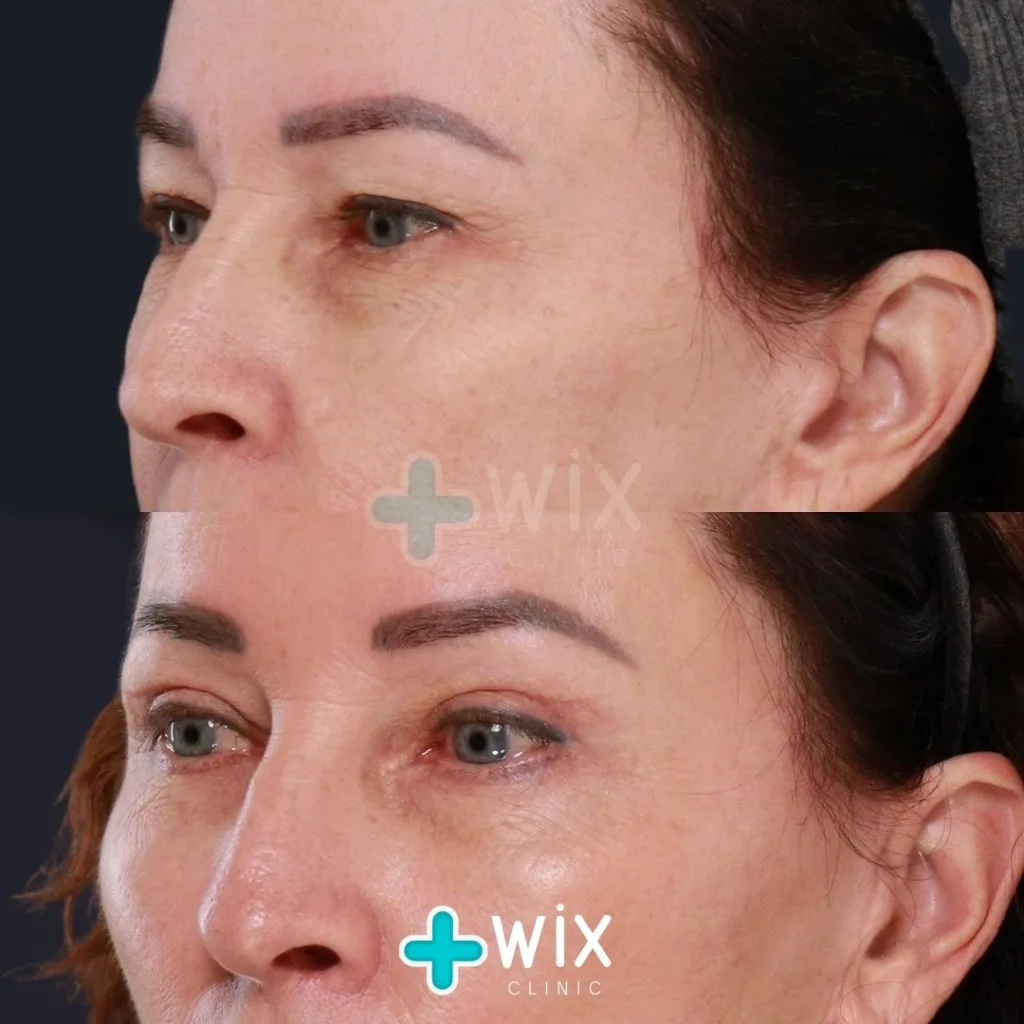 Blepharoplasty Before and After