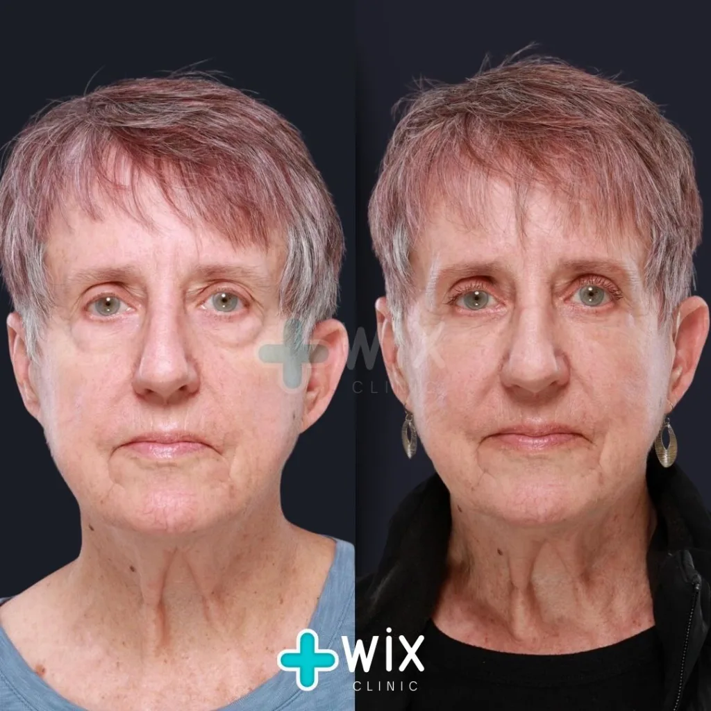 Blepharoplasty Before and After