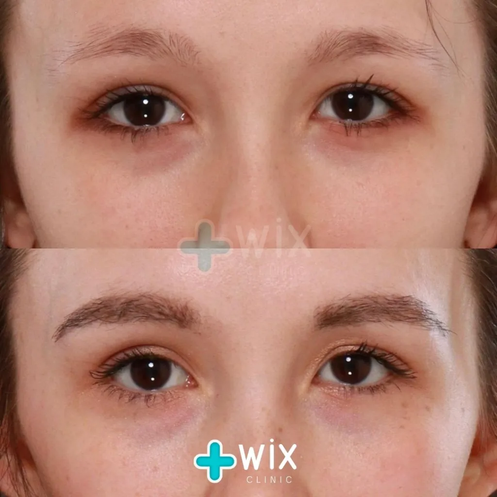 Blepharoplasty Before and After