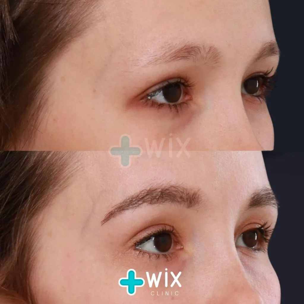 Blepharoplasty Before and After