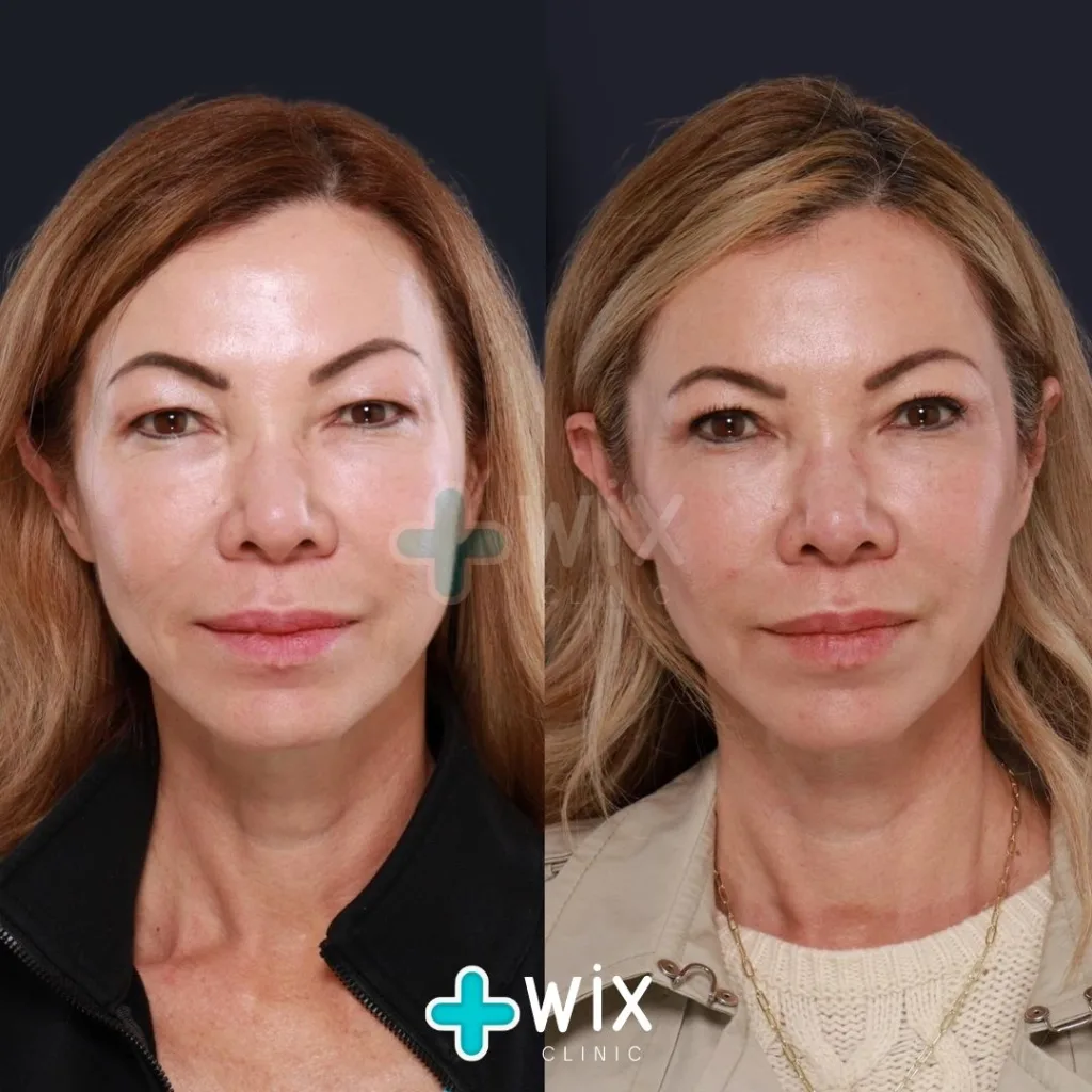 Blepharoplasty Before and After