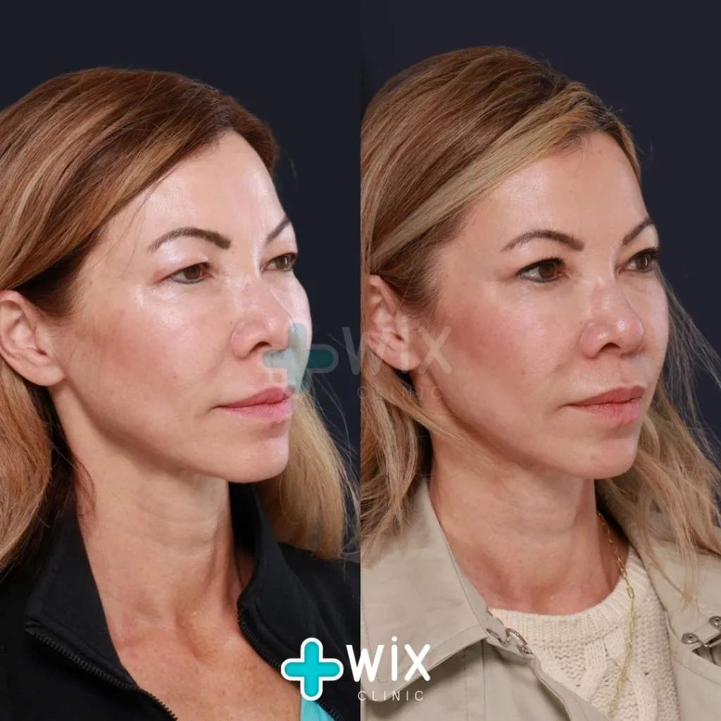 Blepharoplasty Before and After