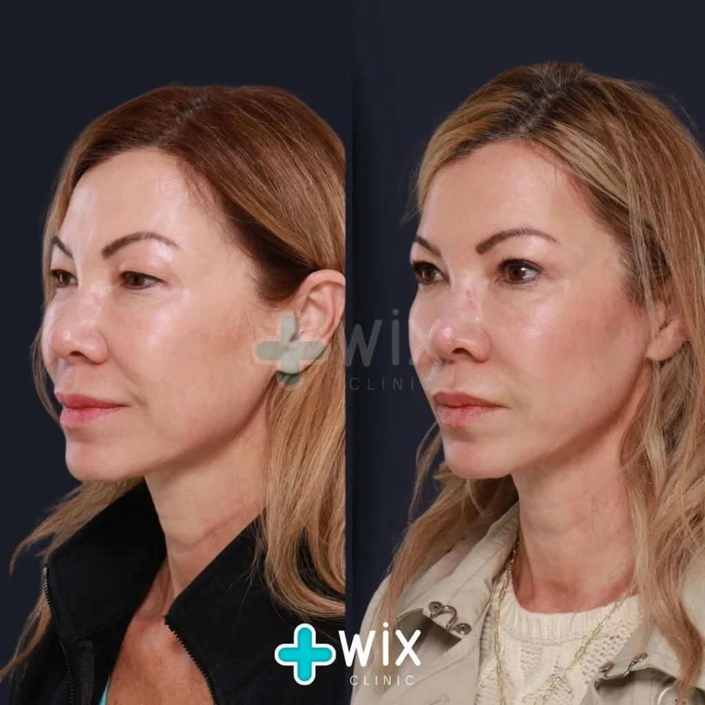 Blepharoplasty Before and After