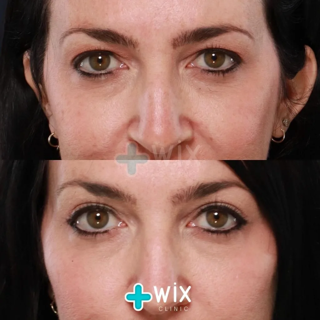 Blepharoplasty Before and After