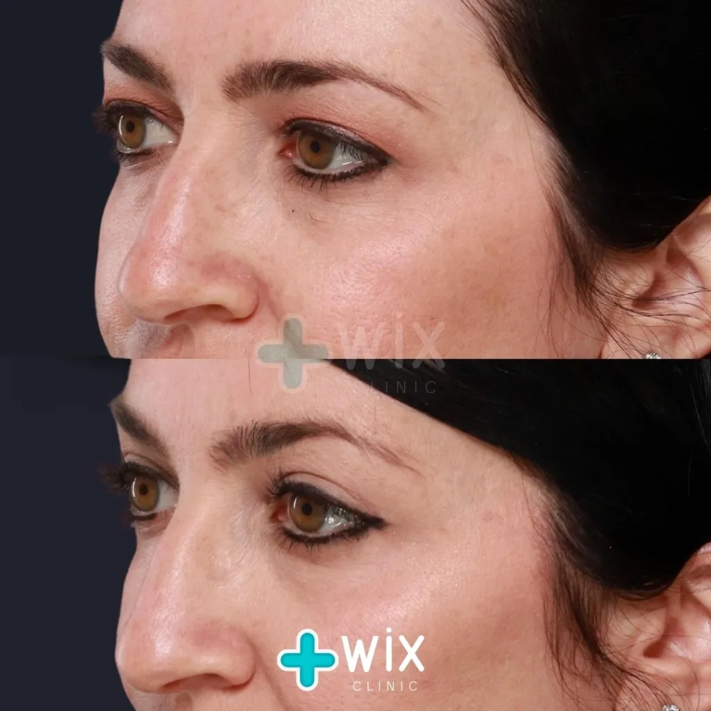 Blepharoplasty Before and After