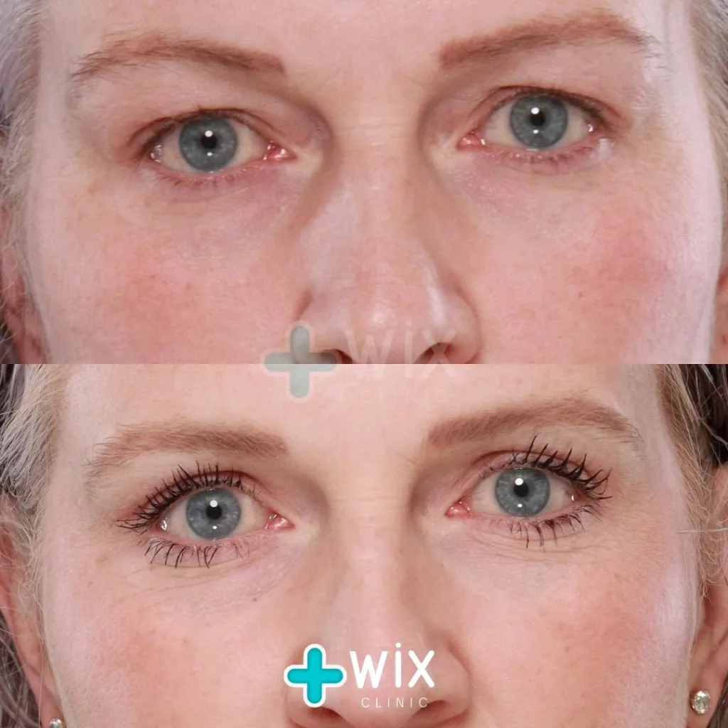 Blepharoplasty Before and After