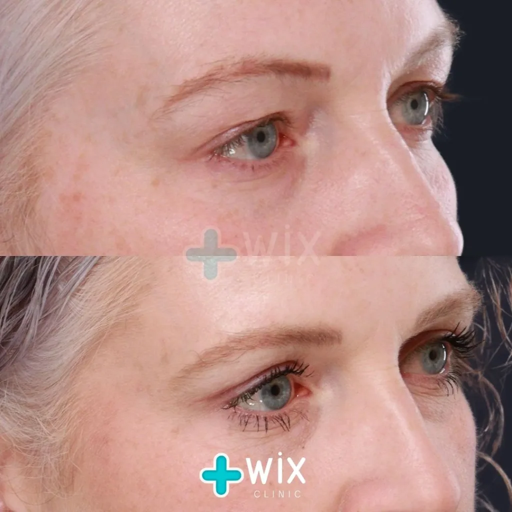 Blepharoplasty Before and After