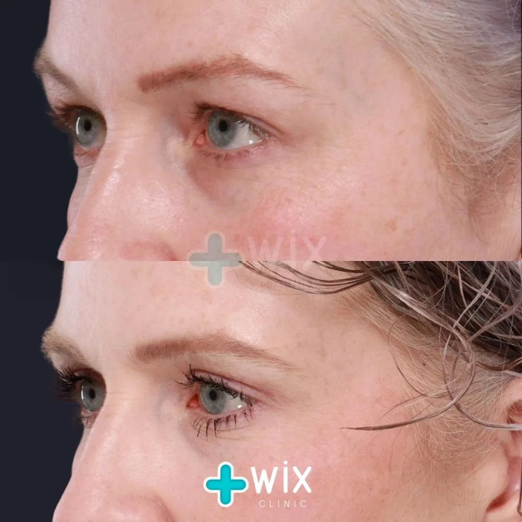 Blepharoplasty Before and After