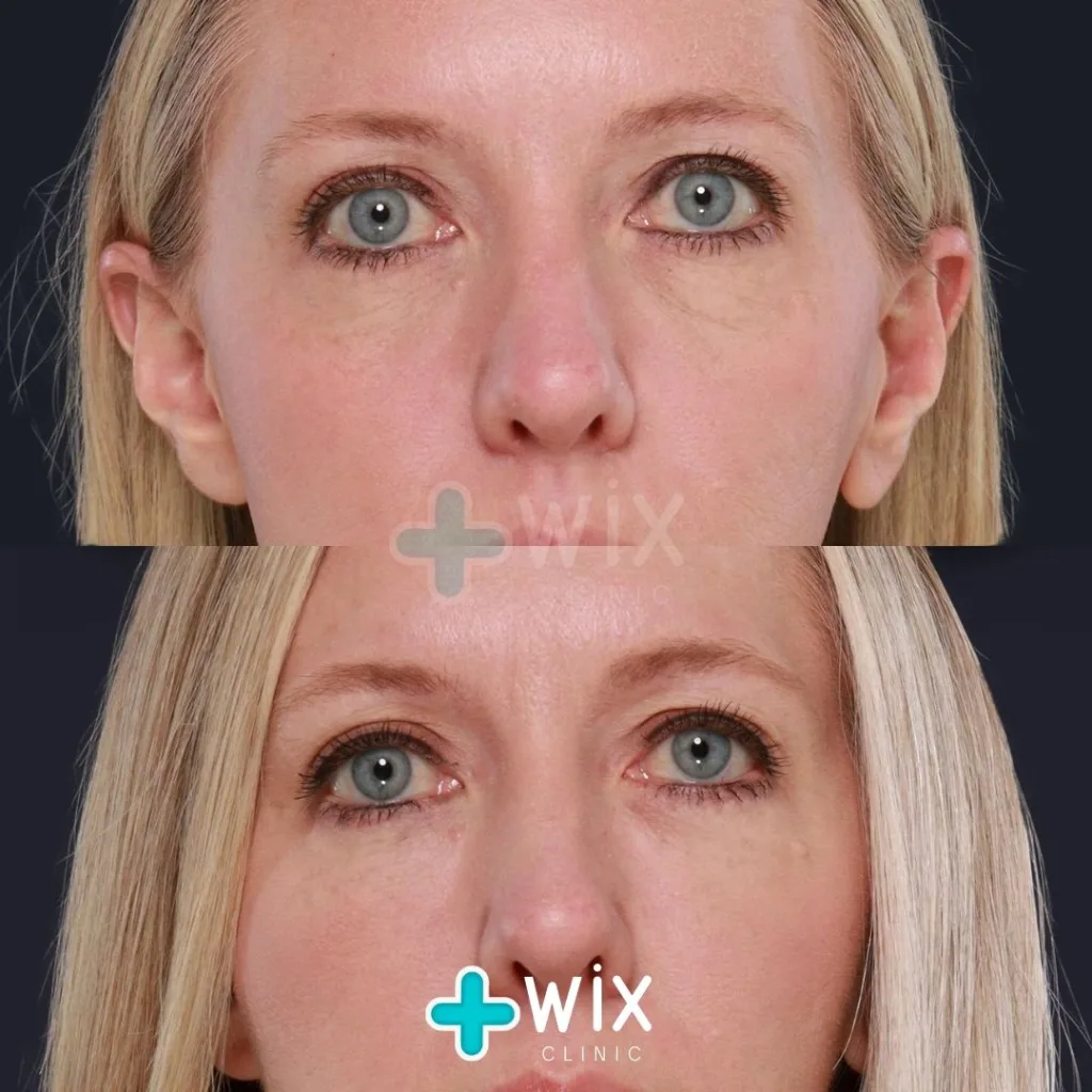 Blepharoplasty Before and After