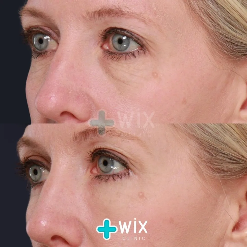 Blepharoplasty Before and After