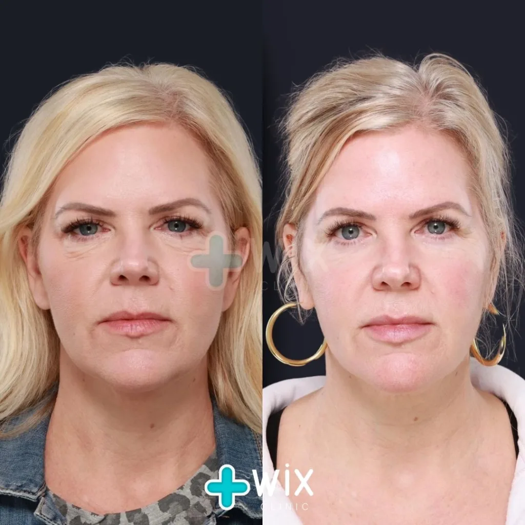 Blepharoplasty Before and After