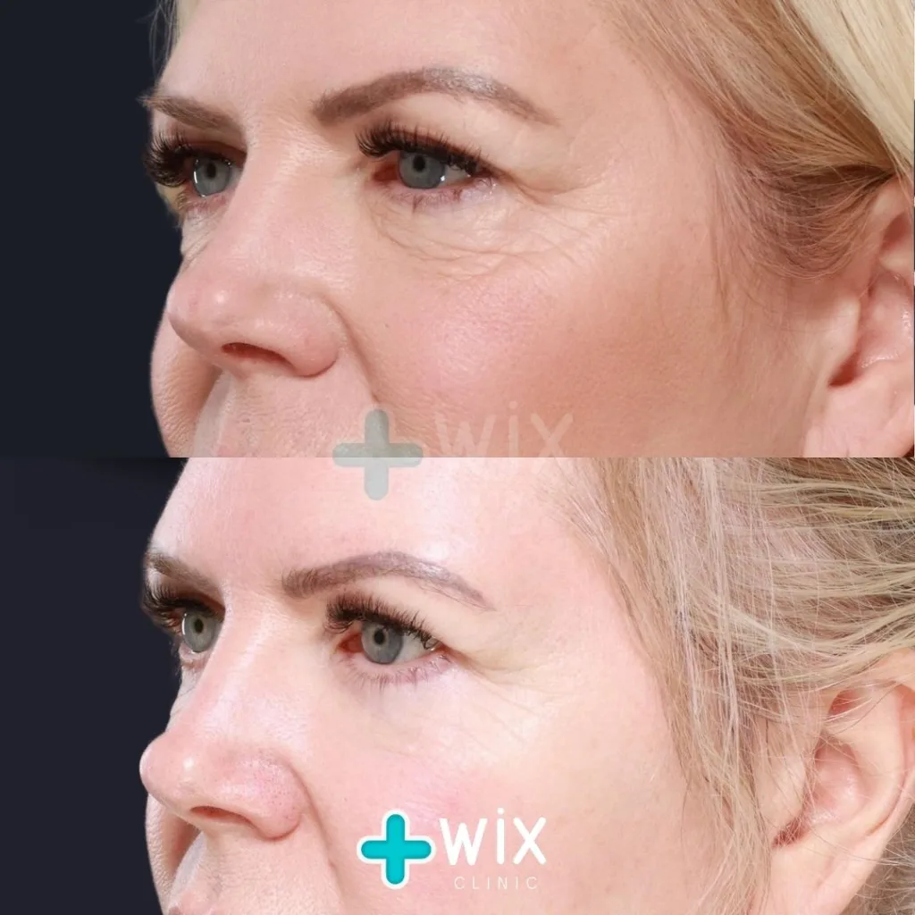 Blepharoplasty Before and After