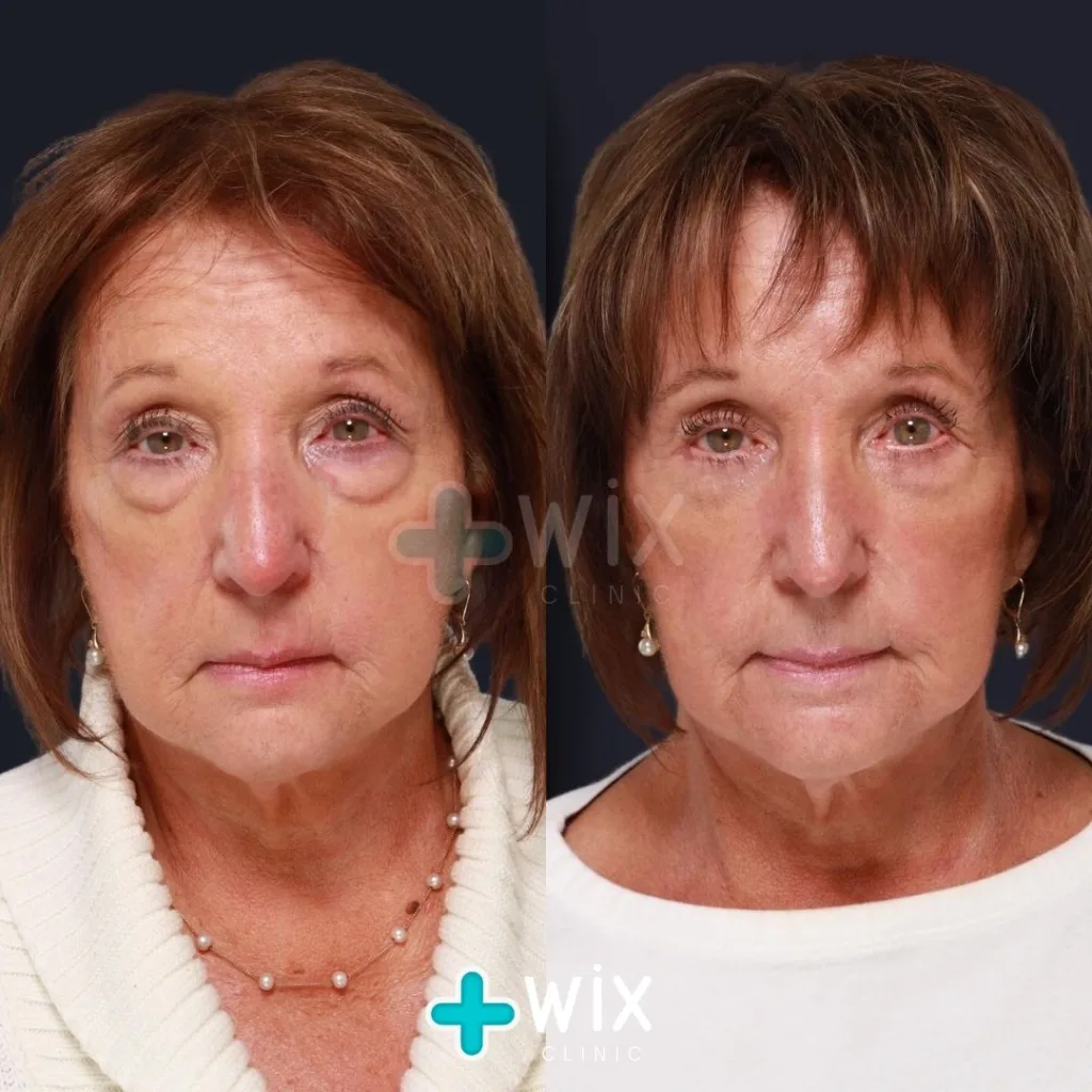 Blepharoplasty Before and After