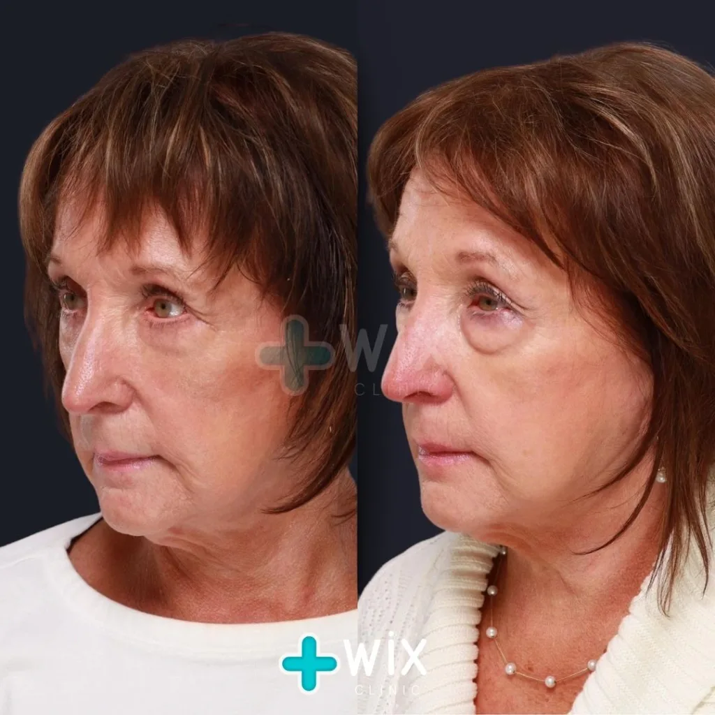 Blepharoplasty Before and After