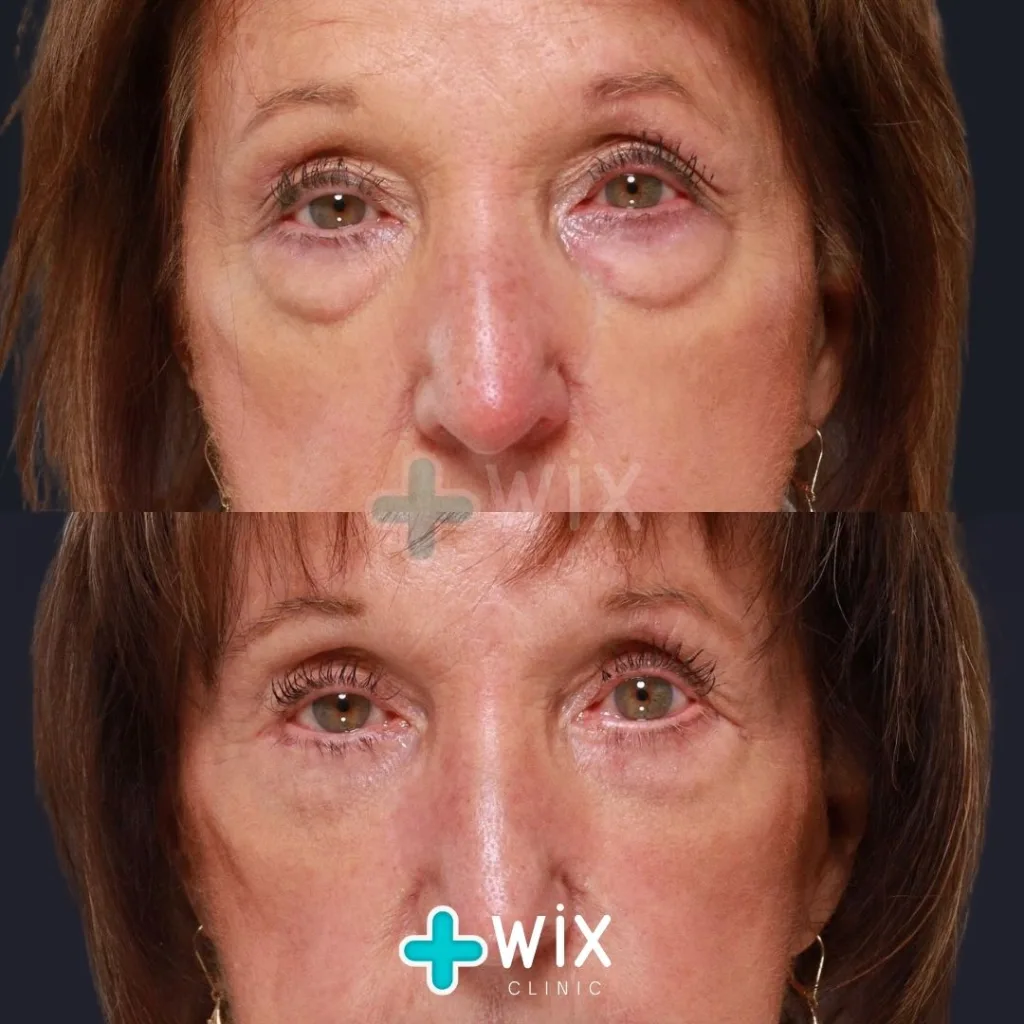 Blepharoplasty Before and After