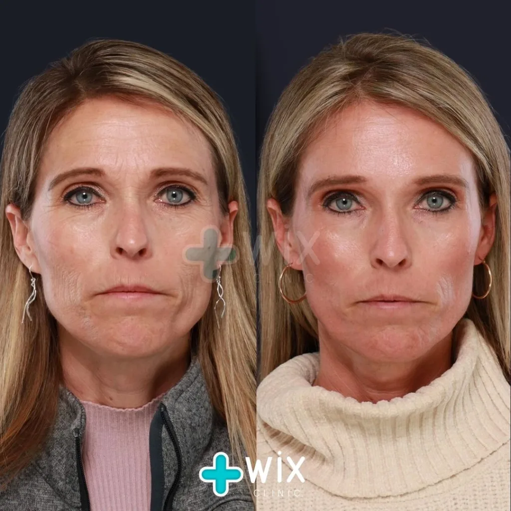 Blepharoplasty Before and After