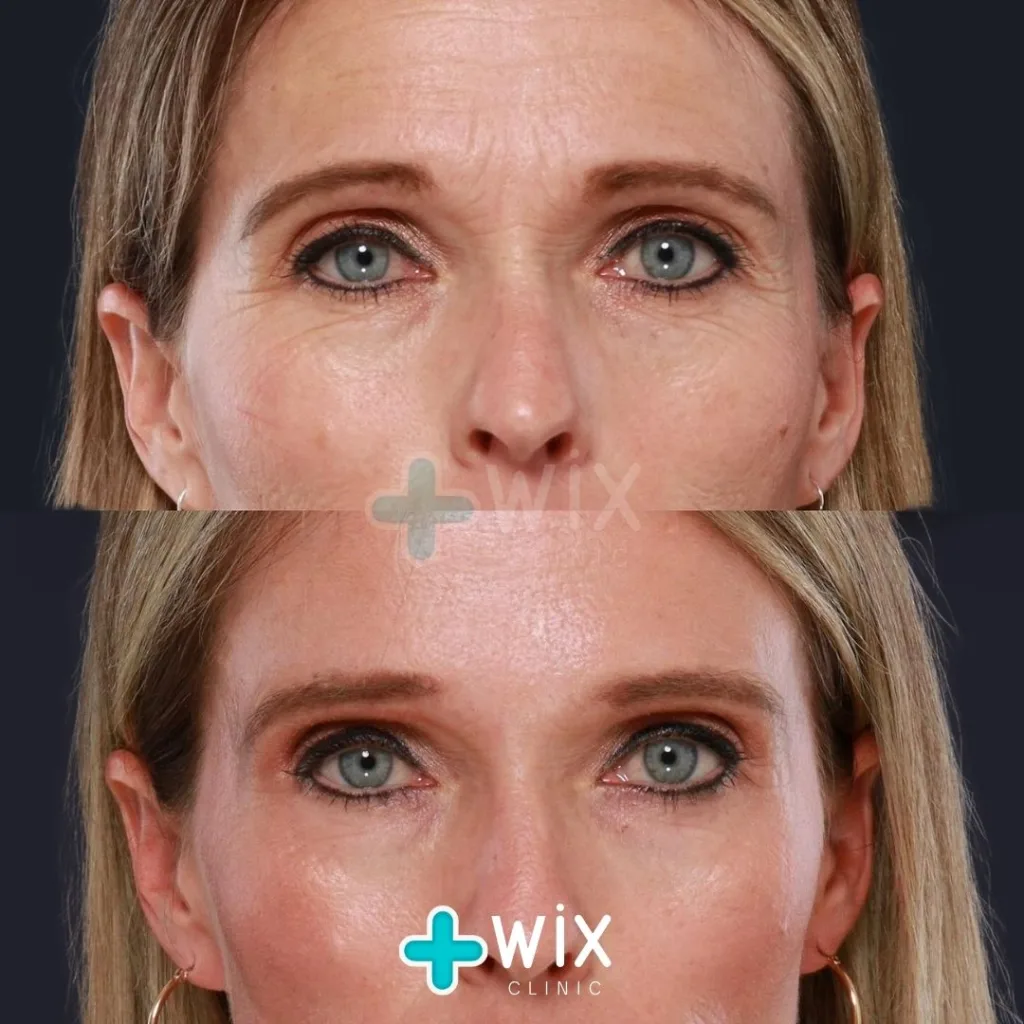 Blepharoplasty Before and After