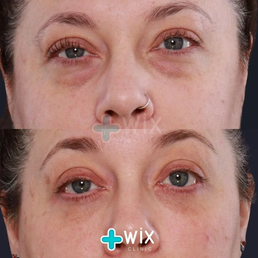 Blepharoplasty Before and After