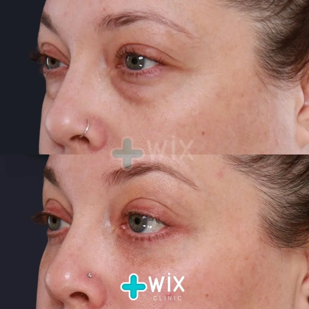 Blepharoplasty Before and After