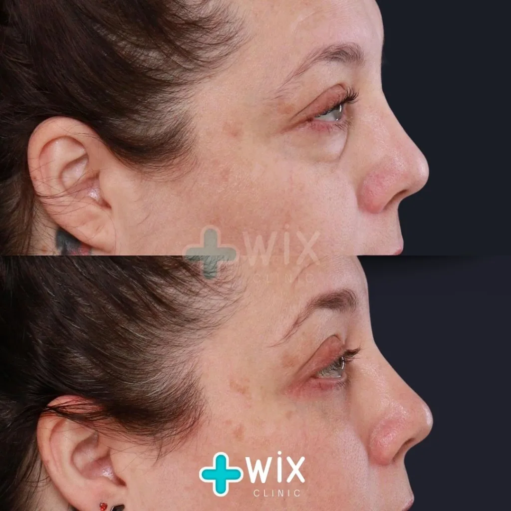 Blepharoplasty Before and After