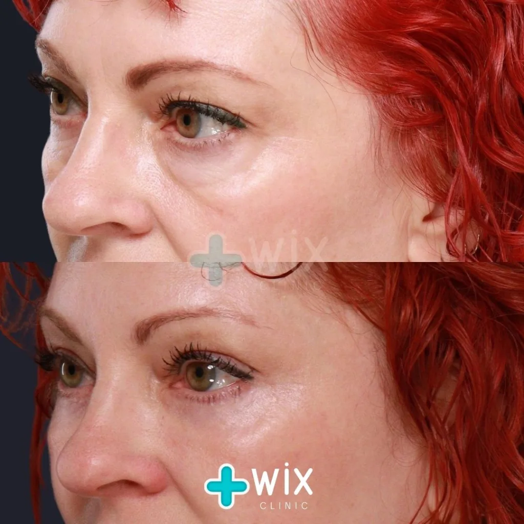 Blepharoplasty Before and After