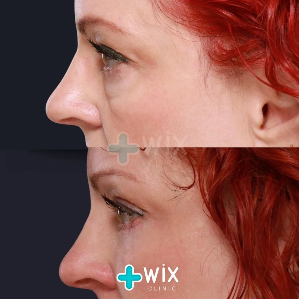 Blepharoplasty Before and After