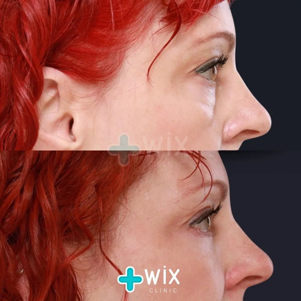 Blepharoplasty Before and After