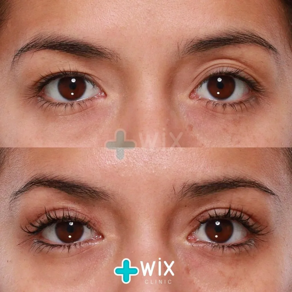 Blepharoplasty Before and After