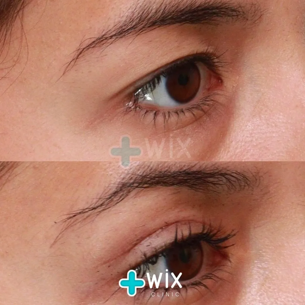 Blepharoplasty Before and After