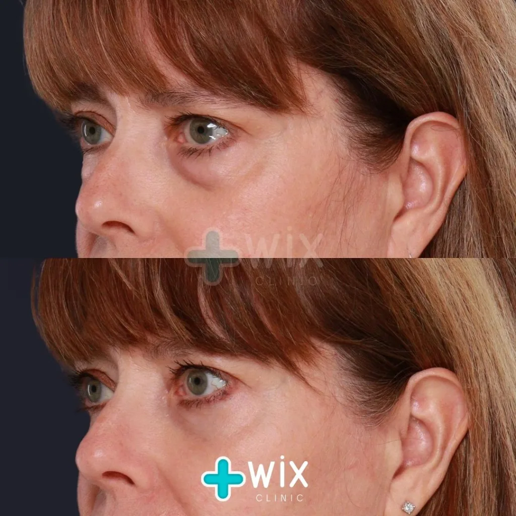 Blepharoplasty Before and After