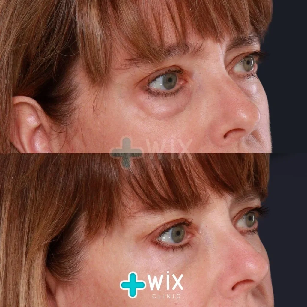 Blepharoplasty Before and After