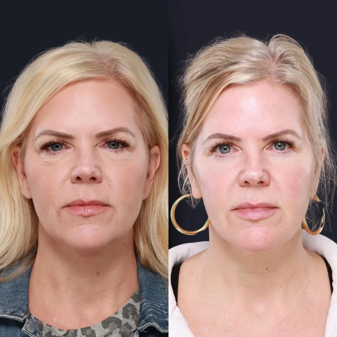 Blepharoplasty Before and After