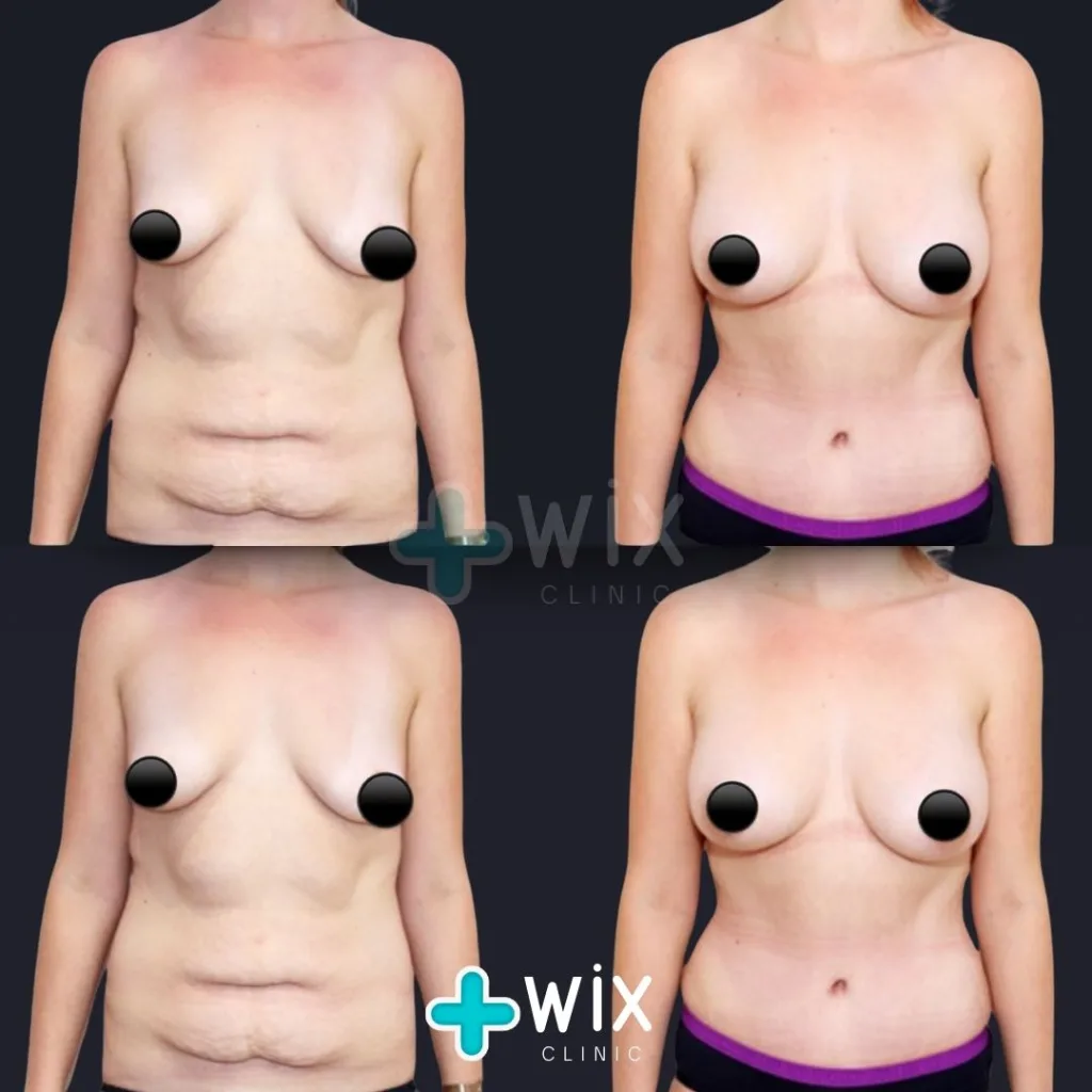 Breast Augmentation Before and After