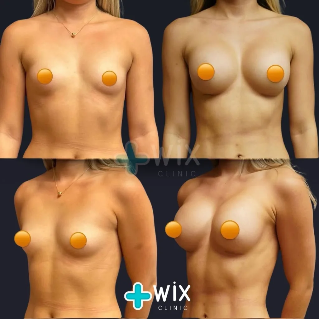 Breast Augmentation Before and After