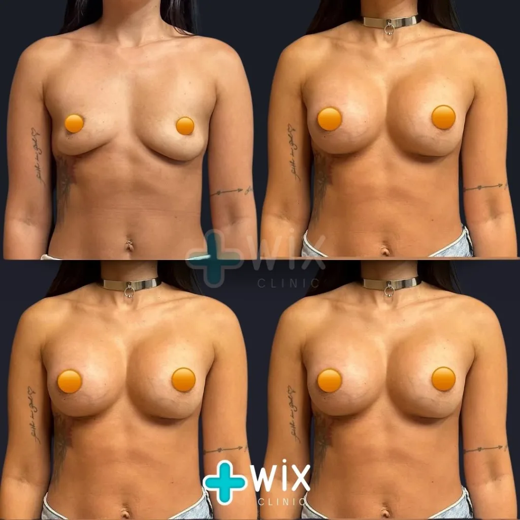 Breast Augmentation Before and After