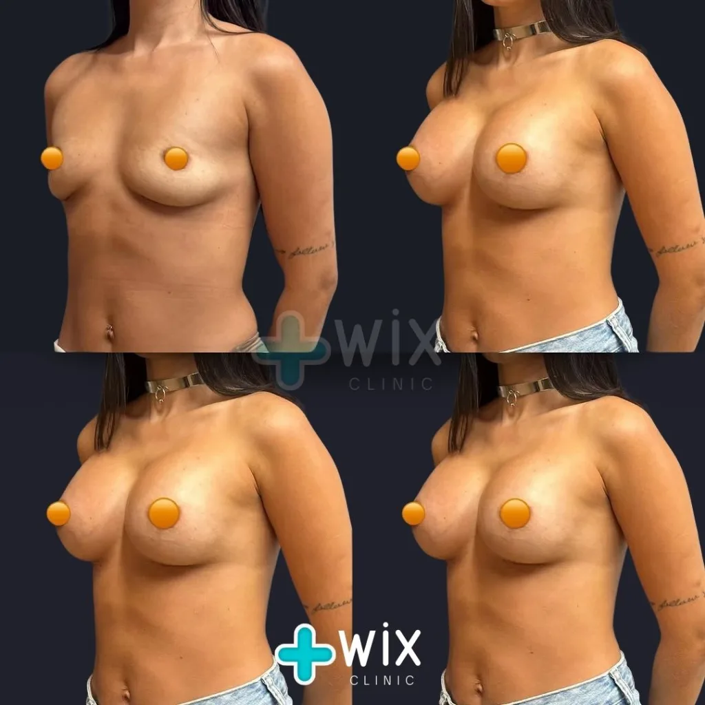 Breast Augmentation Before and After