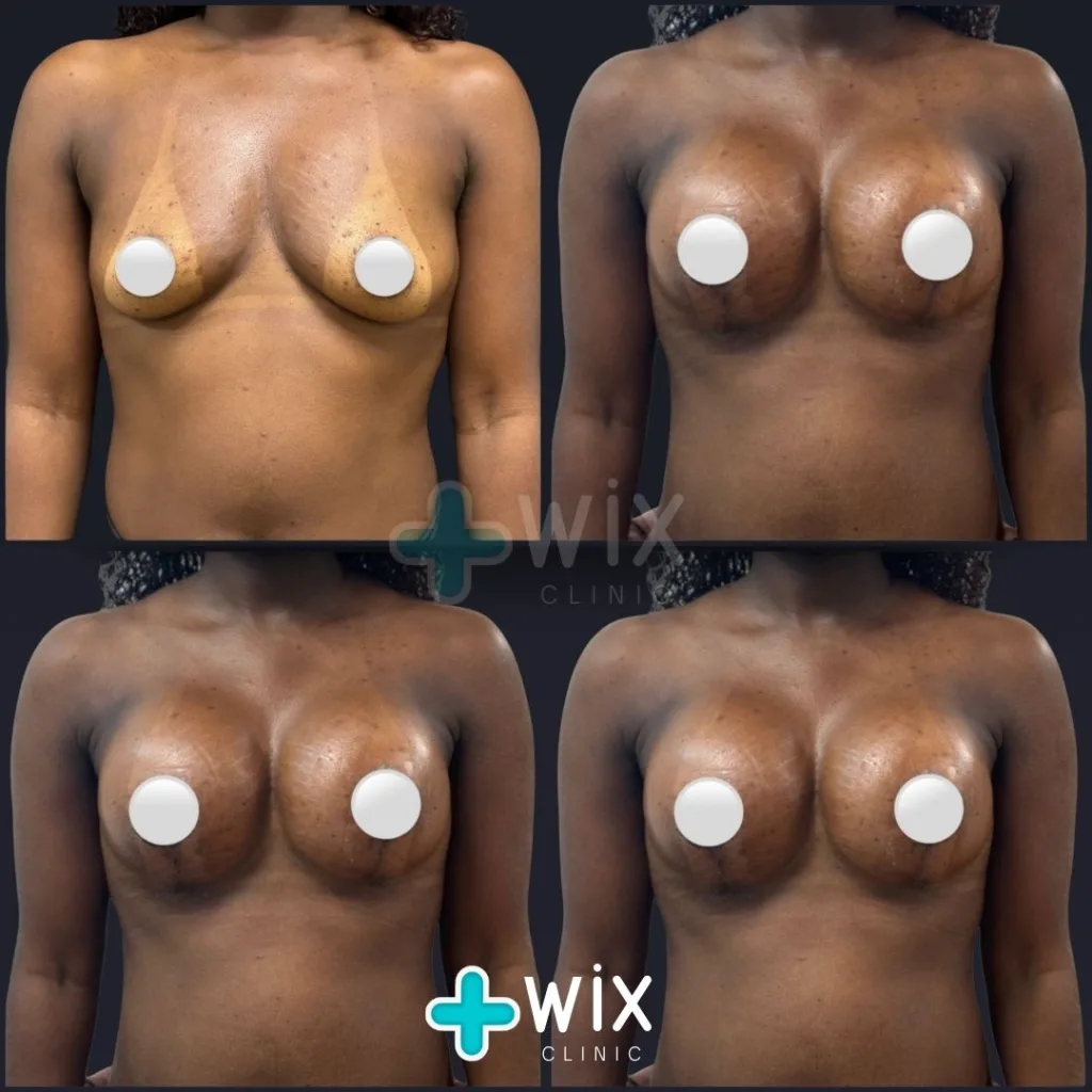 Breast Augmentation Before and After