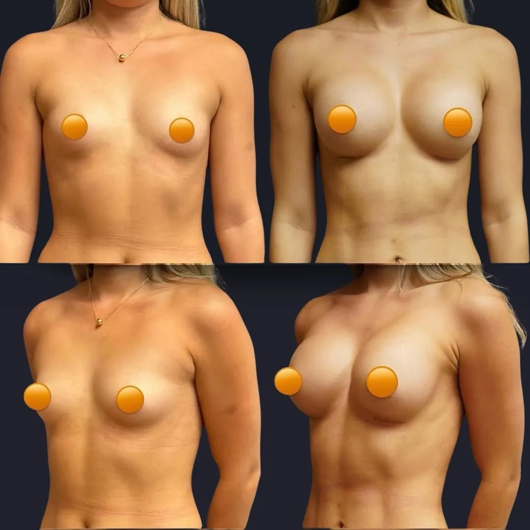 Breast Augmentation in Turkey Before and After