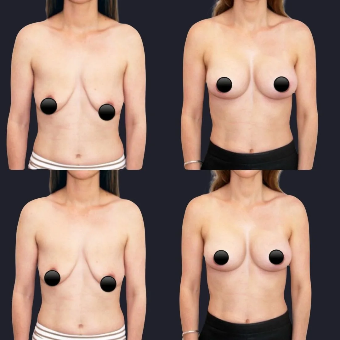 Breast Lift Before and After