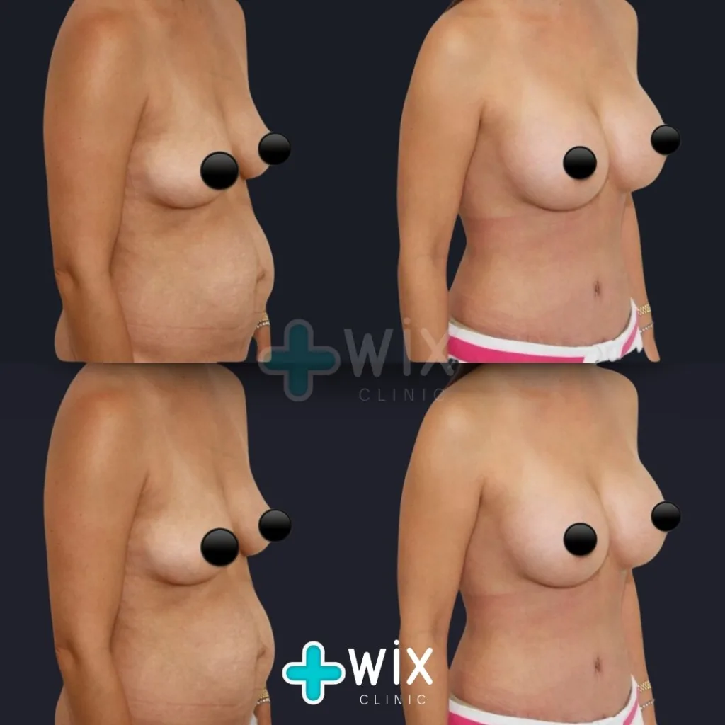 Breast Lift Before and After