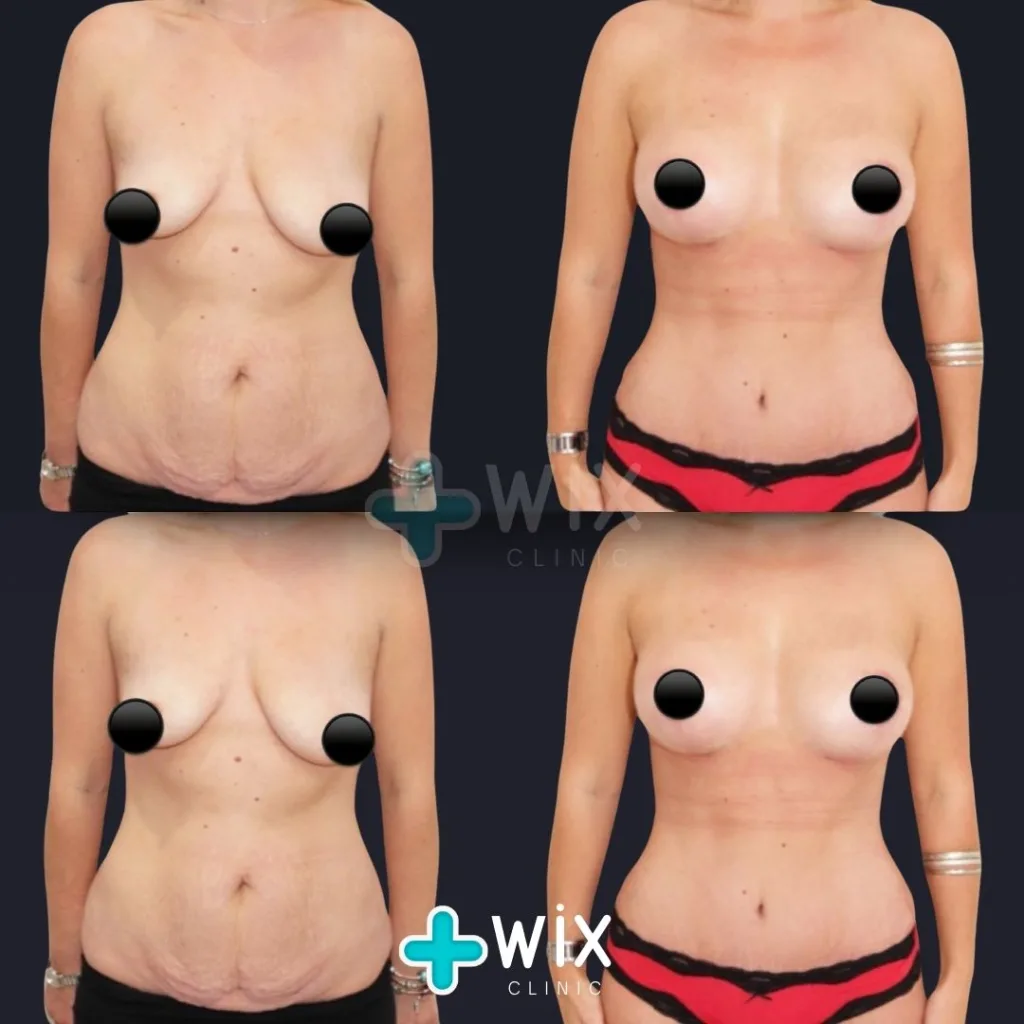 Breast Lift Before and After