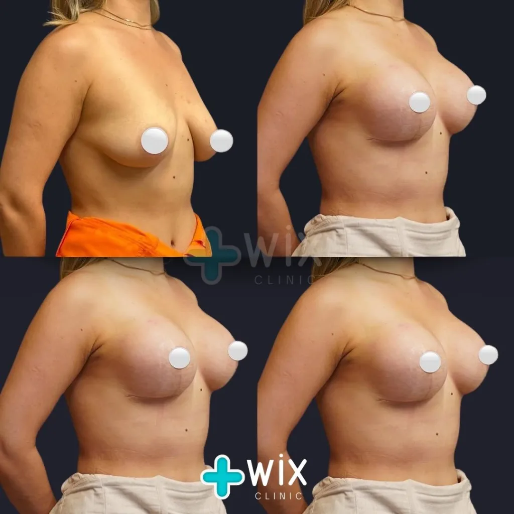 Breast Lift Before and After